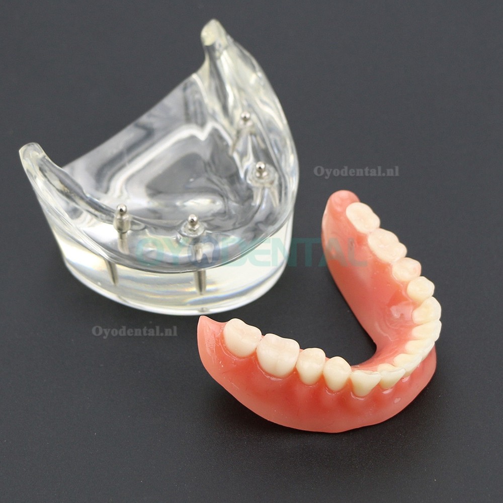 Demo-onderzoek tandheelkundige onderste tanden Model 6002 02 Overdenture Inferior 4 implantaten